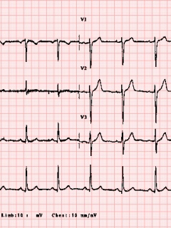 Ηλεκτροκαρδιογράφημα